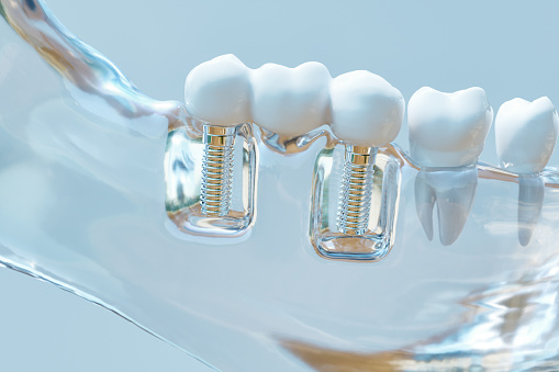 Set of dental implants in clear glass model jaw