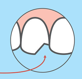 Diagram of chipped front tooth at Myers Park Dental Partners in Charlotte, NC