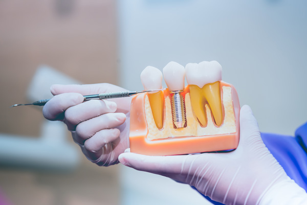 Image of a dental professional pointing to a dental implant model, at Myers Park Dental Partners in Charlotte, NC.