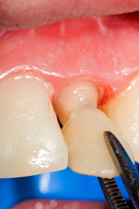 Image of a dental crown being placed at Myers Park Dental Partners in Charlotte, NC.