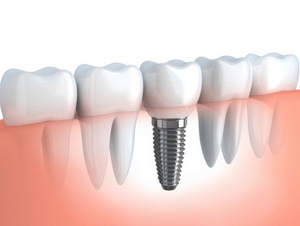 Image of a dental implant at Myers Park Dental Partners.