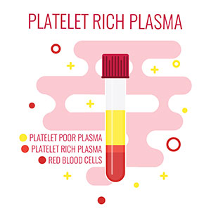 Image of platelet-rich plasma.