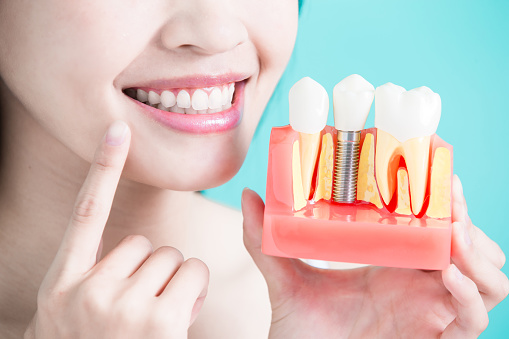 Image of a patient holding a dental implant model and smiling, at Myers Park Dental Partners in Charlotte, NC.