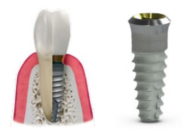 Image of dental implant material at Myers Park Dental Partners in Charlotte, NC.