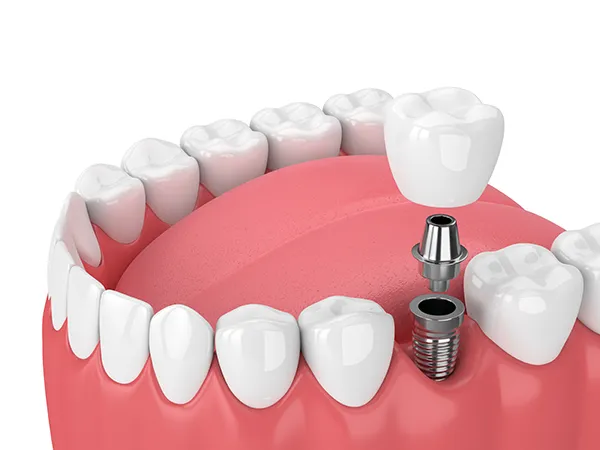 Image of a dental implant and its components being placed into a jaw, at Myers Park Dental Partners in Charlotte, NC.