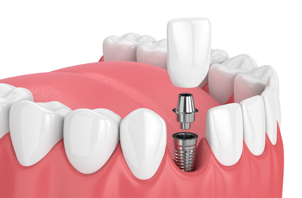 Rendering of jaw with dental implant at Myers Park Dental Partners in Charlotte, NC.