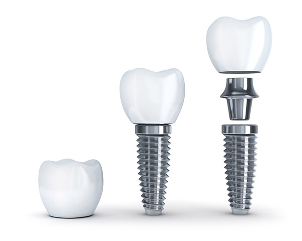 Diagram of dental implant with post from Myers Park Dental Partners in Charlotte, NC