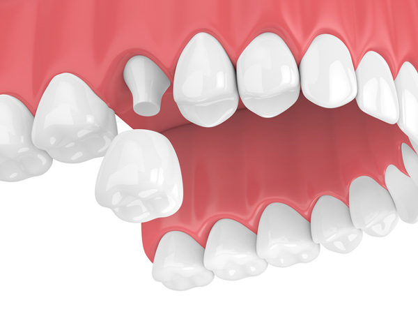 A rendering of a jaw with a porcelain crown