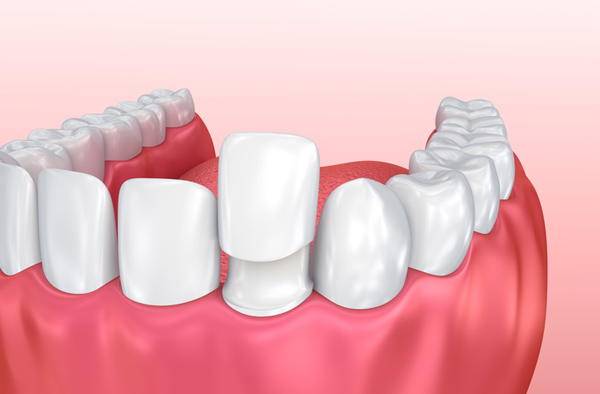 Rendering of jaw with porcelain veneer on tooth from Myers Park Dental Partners in Charlotte, NC