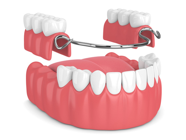 Rendering of removable partial denture at Myers Park Dental Partners in Charlotte, NC