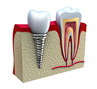 An example of a dental implant at Myers Park Dental Partners in Charlotte, NC