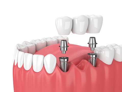A rendering of a jaw with a dental implant bridge